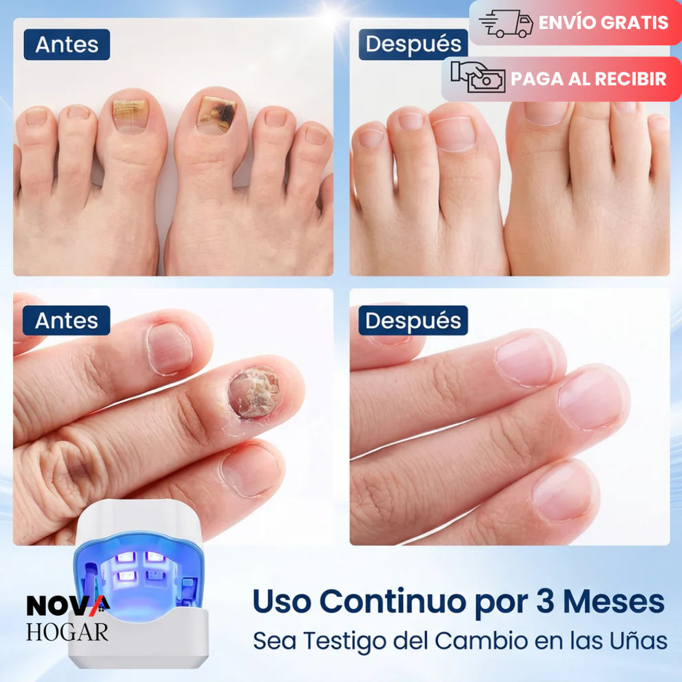 FungusPulse™ Dispositivo Láser Profesional Antihongos